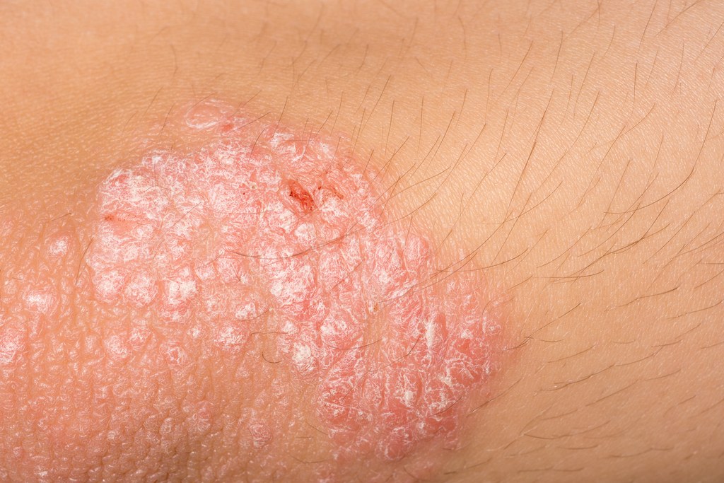 Everything You Need To Know About Psoriasis 