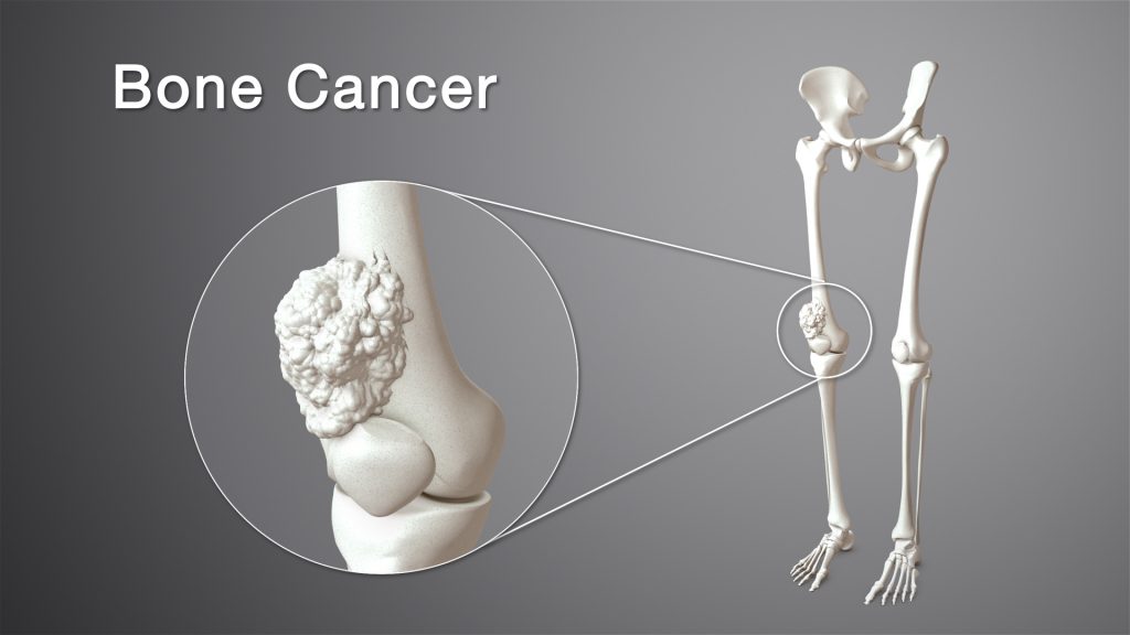Процент на оцеляване на костен рак (костен сарком)