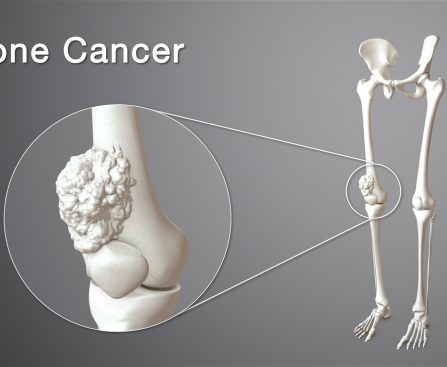Bone-Cancer