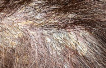 Scalp Build Up and How To Get Rid of It | Inspire Trends