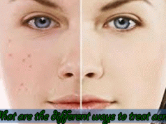What-are-the-different-ways-to-treat-acne
