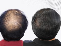 the best hair transplant surgeon in India.