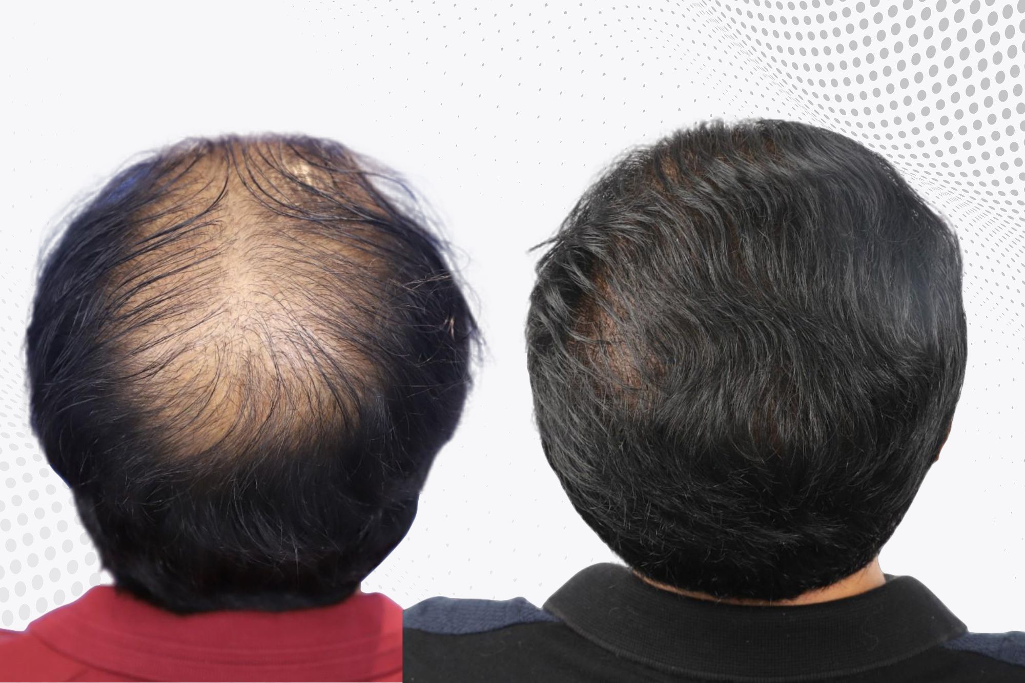 can-fungal-infections-lead-to-hair-loss